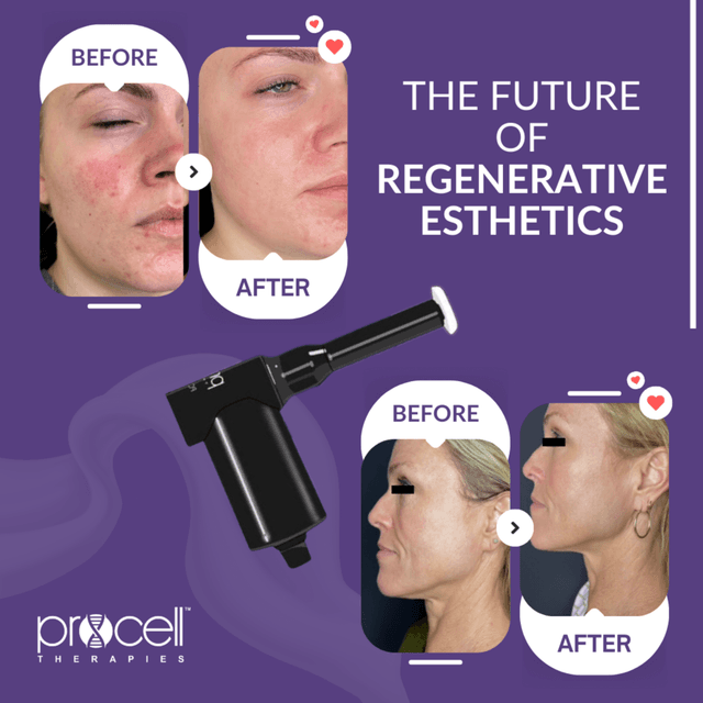 Procell Transformation Series at Elevated Esthetics by Alena in Richmond, MO